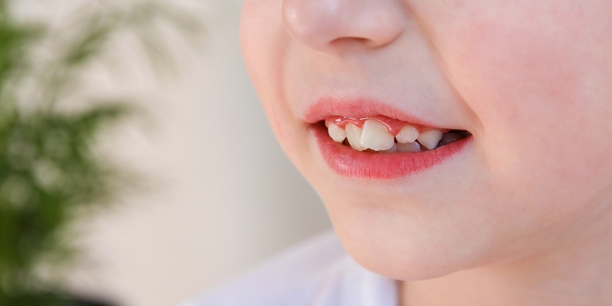 子どもの「お口の発達」が将来の歯並びに影響？