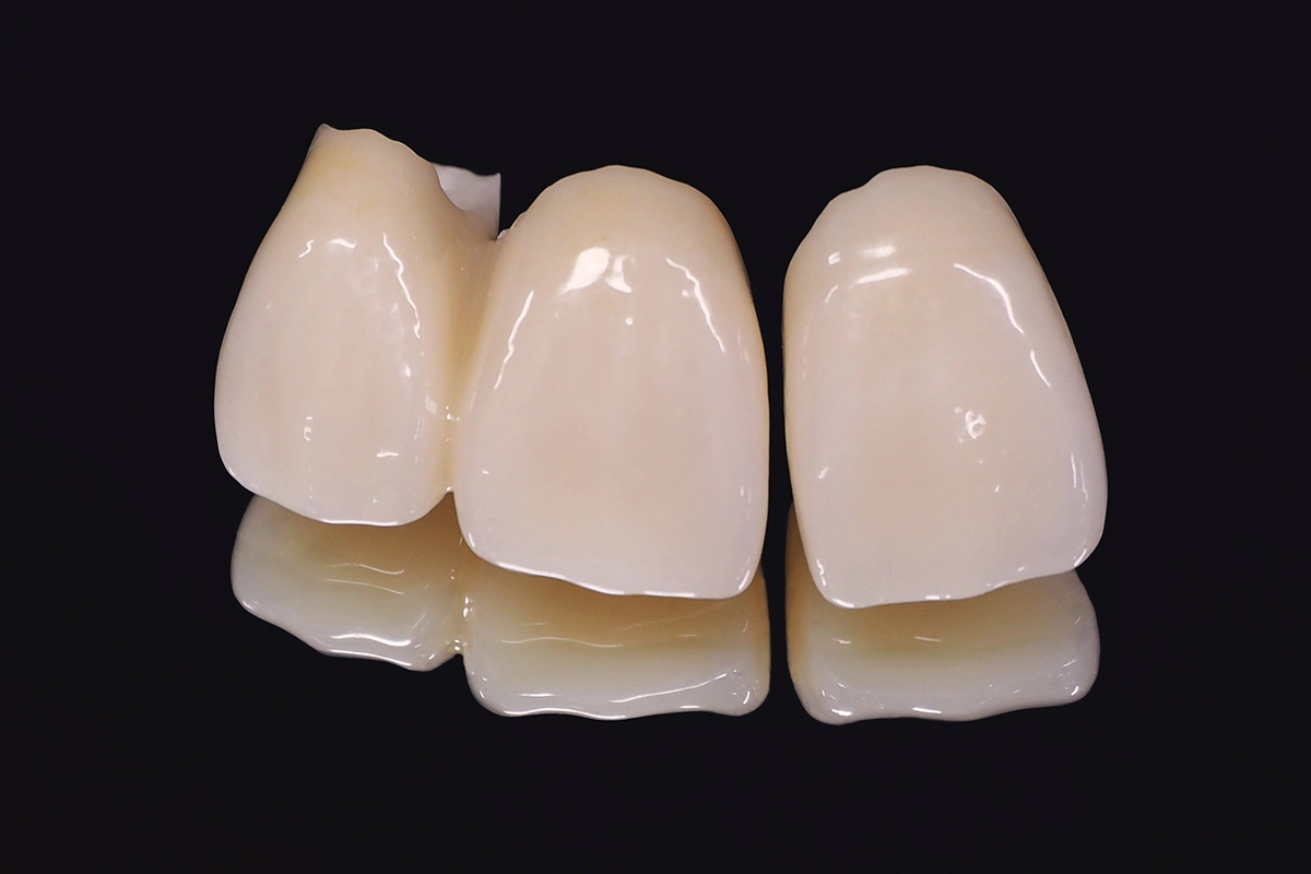 保険適用の白い被せ物「CAD/CAM冠」の注意点