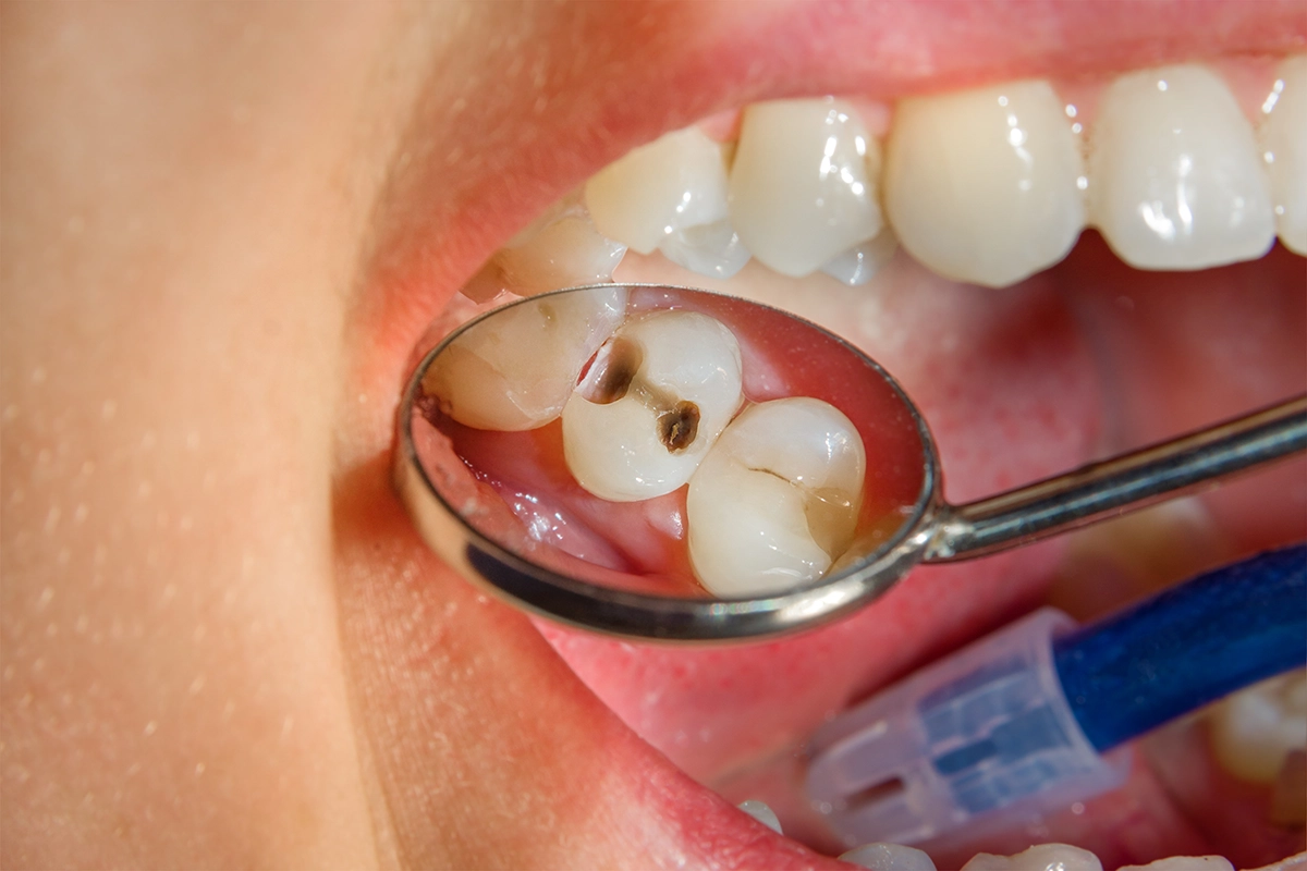 虫歯のよくある初期症状