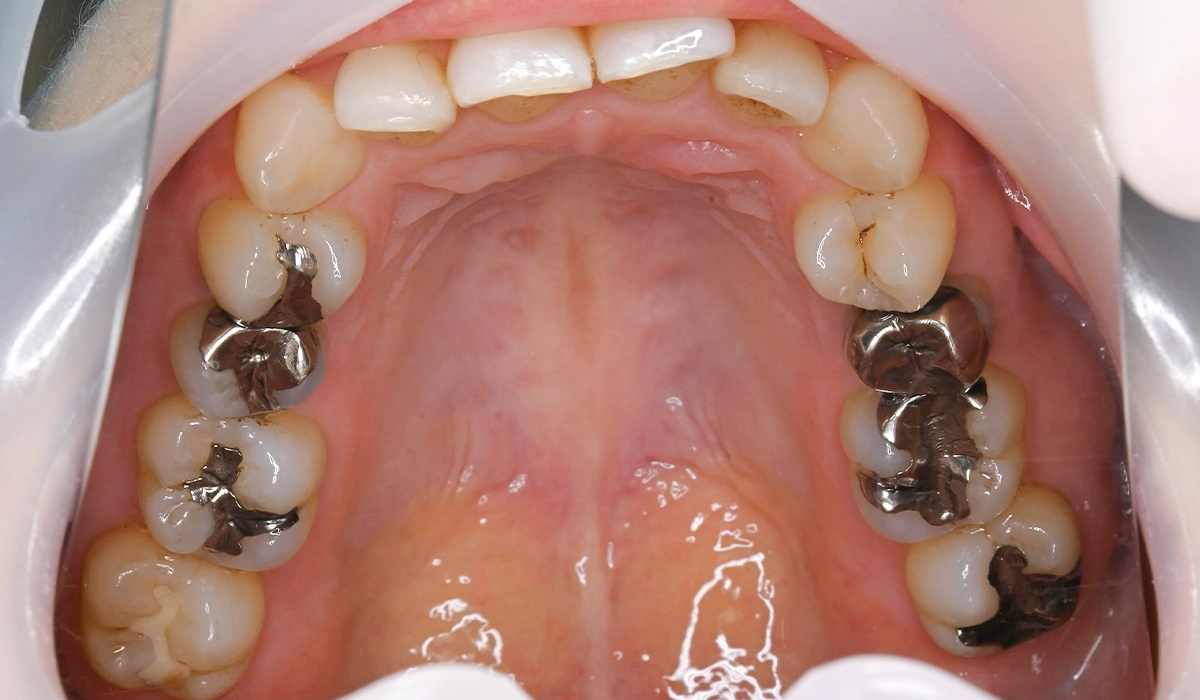 Before 上顎